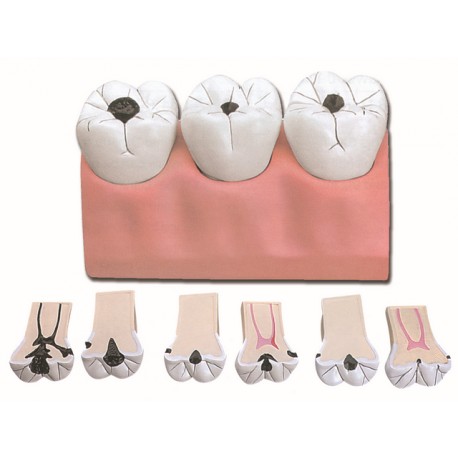 CARIES DENTAIRES